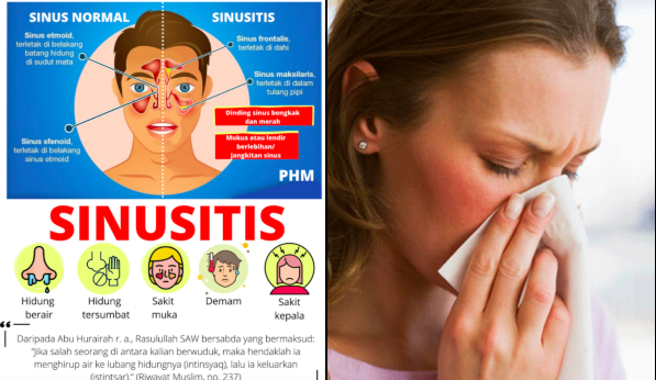 Punca Radang Sinus Sinusitis And Cara Atasinya Sebelum Lebih Teruk