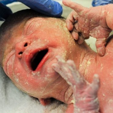 vernix caseosa